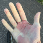 Vita fingrar (Raynauds fenomen): orsak, symtom & behandling